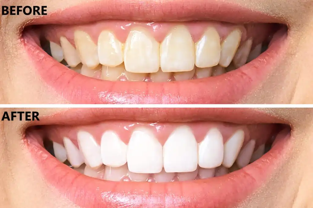 Teeth-Whitening