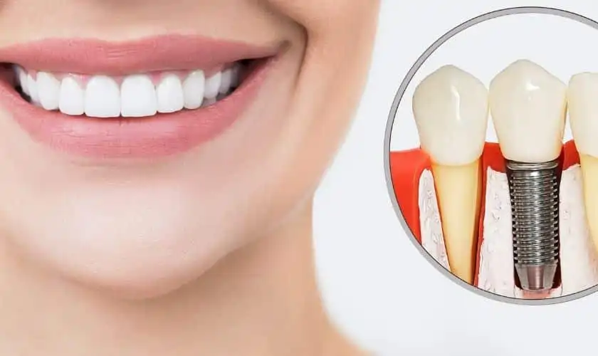 Dental-Implants
