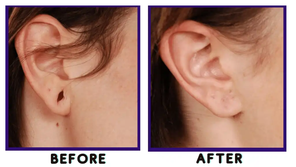 Earlobe-Repair